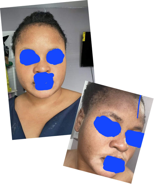 PHYTO COLLAGÈNE, FURFELLA BOOSTER , VITAMINE C ASCORBIC GLUTATHIONE WHITENING BYE BYE BOUTONS HYPER PIGMENTATION