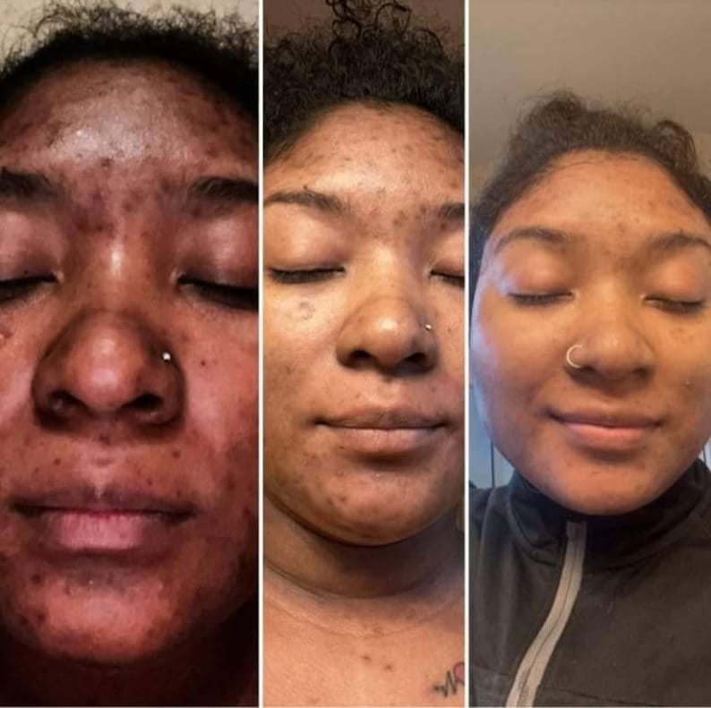 X2 SAVON KOJIC SAN CONTRE LES TÂCHES, HYPER PIGMENTATION, ECLAIRCISSANT AUTHENTIQUE