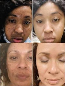 1 PIÈCE, P- CARE CRÈME ANTI FARDS, HYPER- PIGMENTATION , AUX EXTRAITS DES GINGEMBRE (THAÏLANDE )