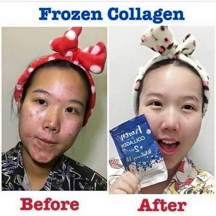FROZEN COLLAGÈN GLUTATHIONE WHITENING CONTRE LES TÂCHES, LES BOUTONS ET VERGETURES 60 CAPSULES