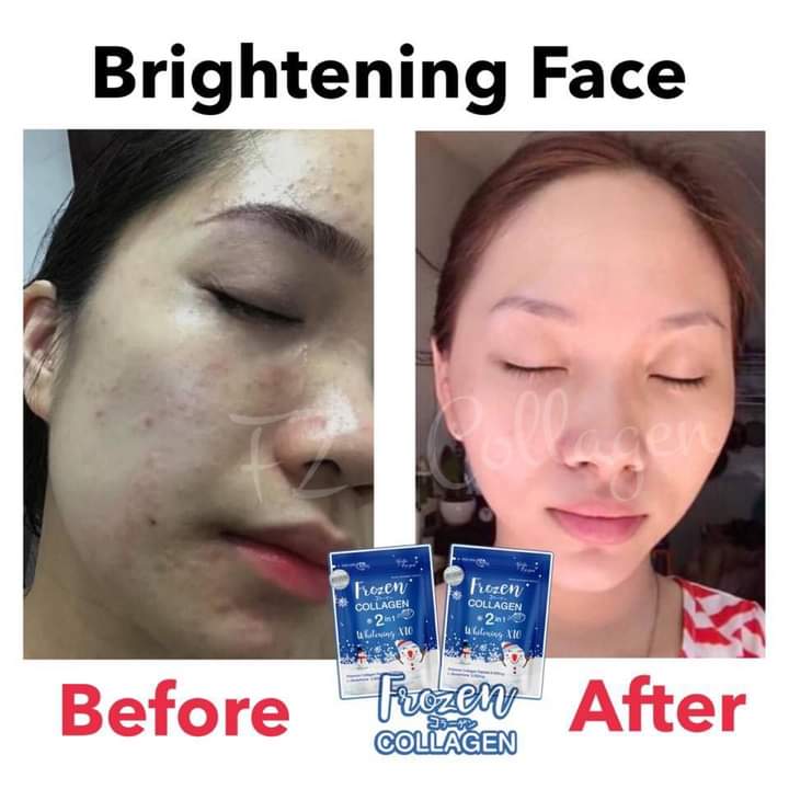 FROZEN COLLAGÈN GLUTATHIONE WHITENING CONTRE LES TÂCHES, LES BOUTONS ET VERGETURES 60 CAPSULES