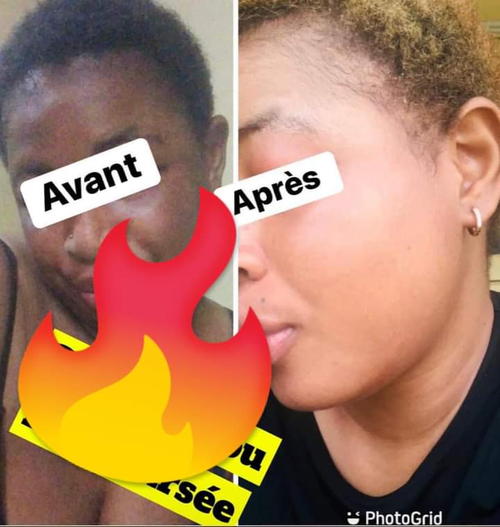 10 Injections buvable glutathione, Vitamine C blanchissant anti vergetures...