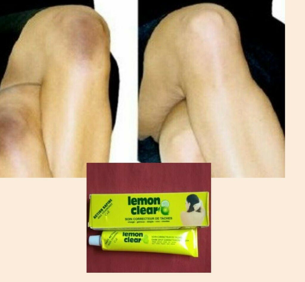Lemon clear tube crème éclaircissant anti taches sur le doigt, tâches rebelles
